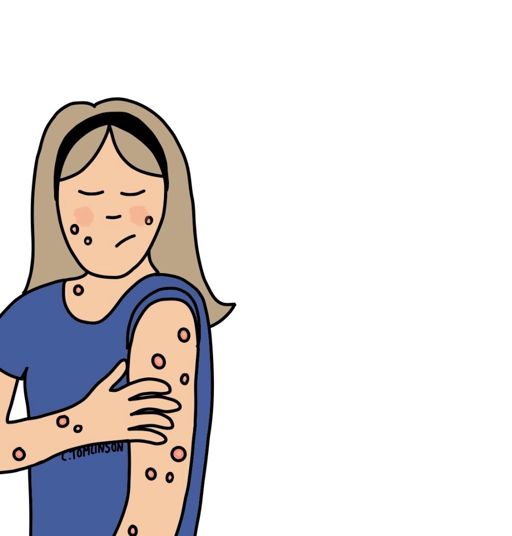 The Hidden Impact of Mpox&nbsp;Stigma