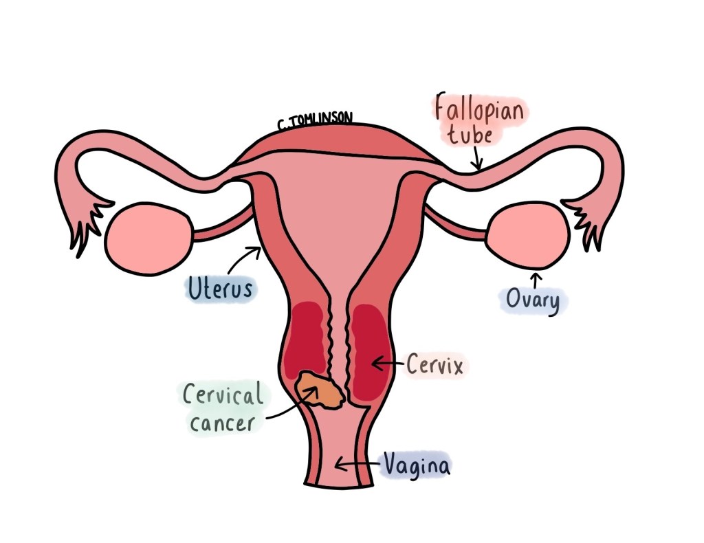 Medical Marvel Monday: Can One Vaccine Bring Cervical Cancer Deaths Close to&nbsp;Zero?